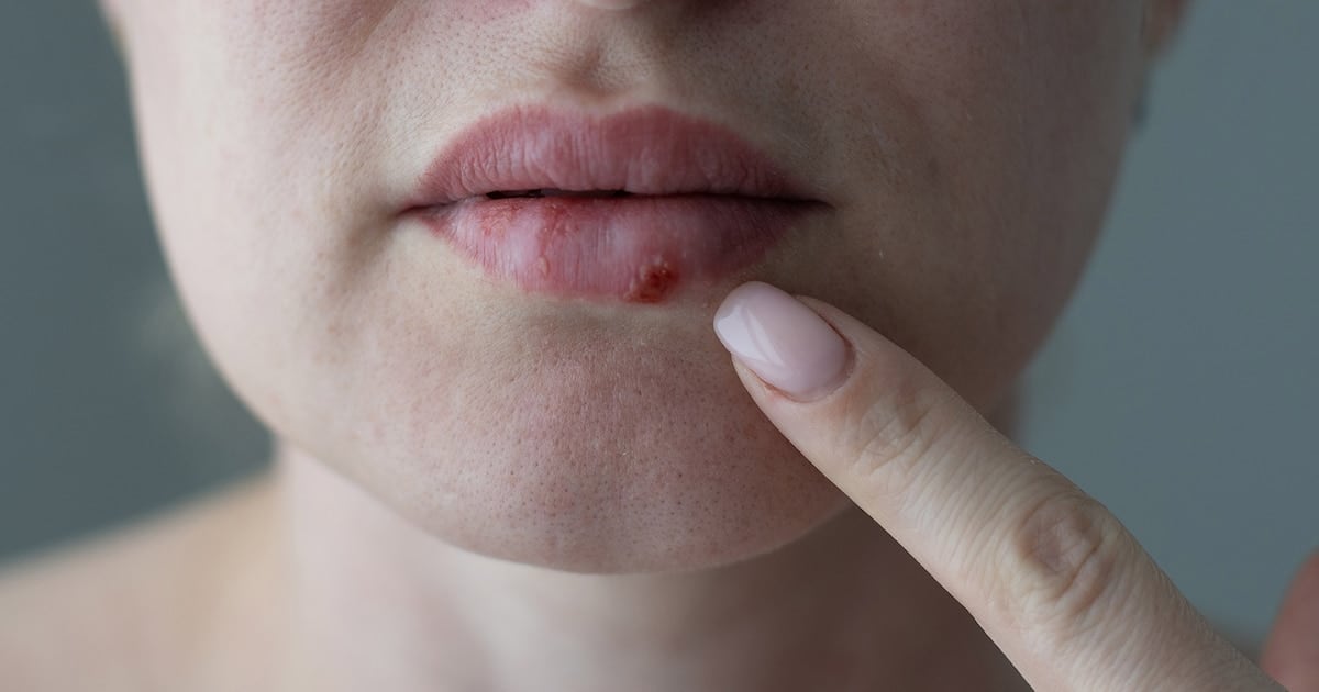 Aprobaron en Estados Unidos el primer antiviral oral nuevo contra el herpes resistente en casi treinta años