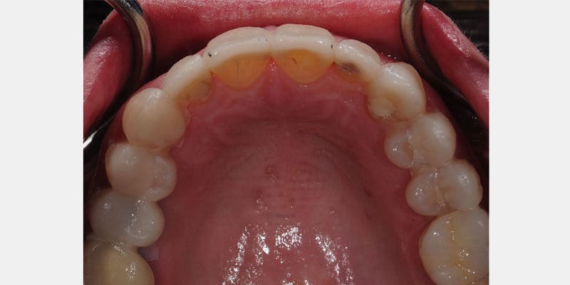 Carillas dentales: las señales de una filtración que puedenPut